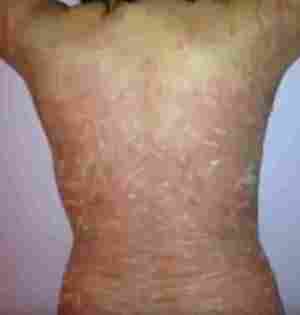 Łuszczyca - diagnoza lub wyrok